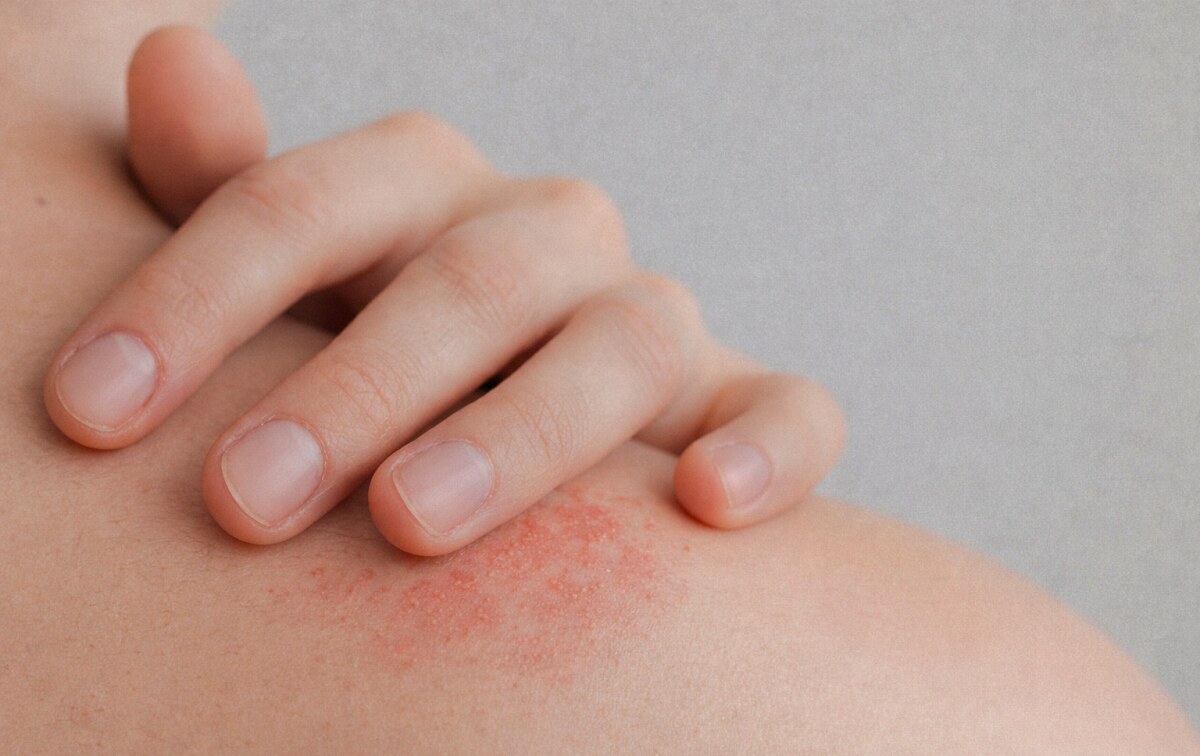 skin rashes